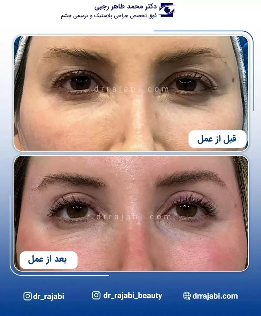 جراحی پلک